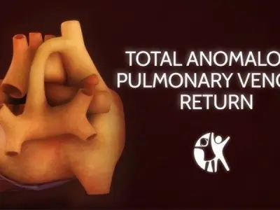 Total Anomalous Pulmonary Venous Return (TAPVR) overview