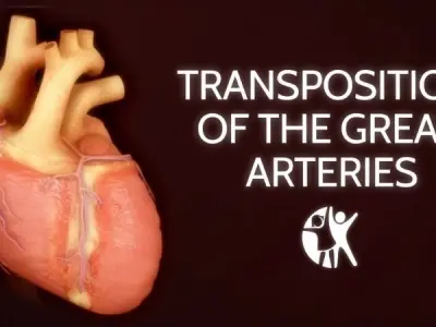 Transposition of the Great Arteries (TGA) long term outlook