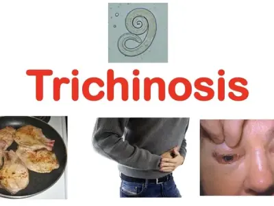 Trichinosis - Symptoms of trichinosis infection to know