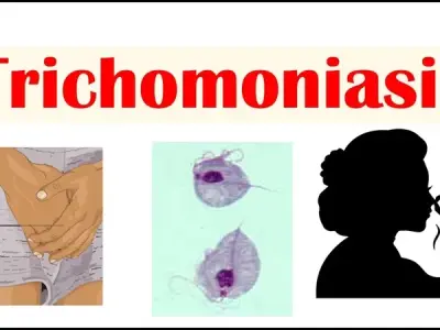 Trichomoniasis - The most common non-viral STI