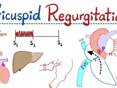 Tricuspid Regurgitation (Insufficiency) medical insights