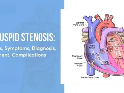 Tricuspid stenosis causes symptoms diagnosis and care