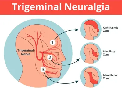 Trigeminal neuralgia - A guide to managing facial pain