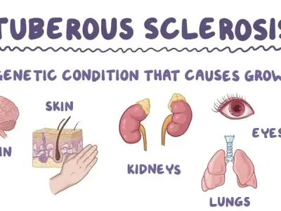 Managing seizures in patients with tuberous sclerosis