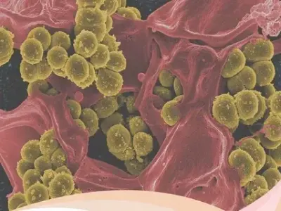 Ureaplasma infection - Is it a pathogen or commensal?