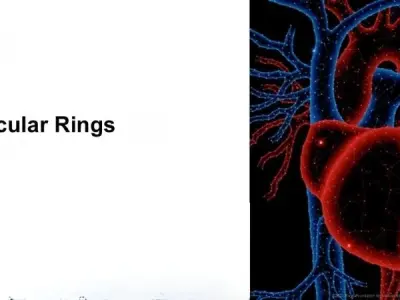 Vascular Rings complications and long term health effects