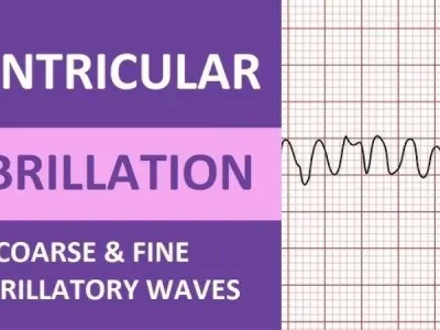 Ventricular Fibrillation (V-Fib) warning signs to know
