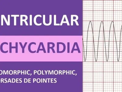 Ventricular Tachycardia (V-Tach) prevention and therapy