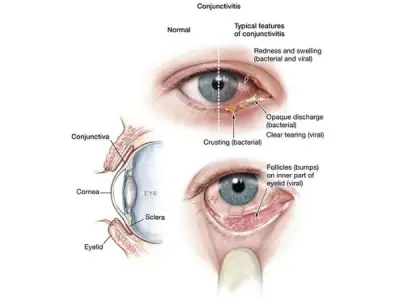 Understanding viral conjunctivitis (Pink Eye) symptoms