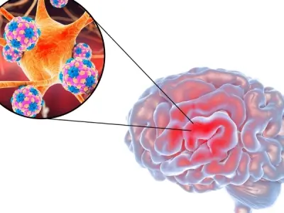 Viral meningitis causes symptoms and treatment guide