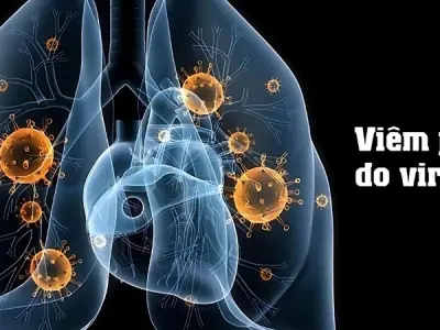 Understanding viral pneumonia symptoms and causes today