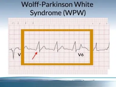 Wolff Parkinson White (WPW) Syndrome causes explained