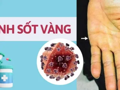 Understanding Yellow Fever symptoms and prevention tips