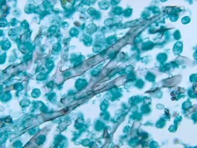 Early diagnosis is critical in rhino-orbital zygomycosis