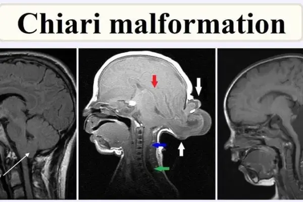 Living with a chiari malformation - A patient's guide