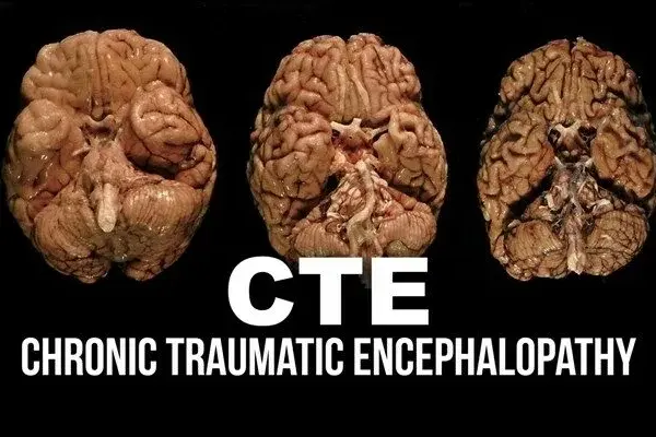 Chronic traumatic encephalopathy - The hidden risks