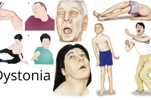 How is dystonia diagnosed and effectively treated?