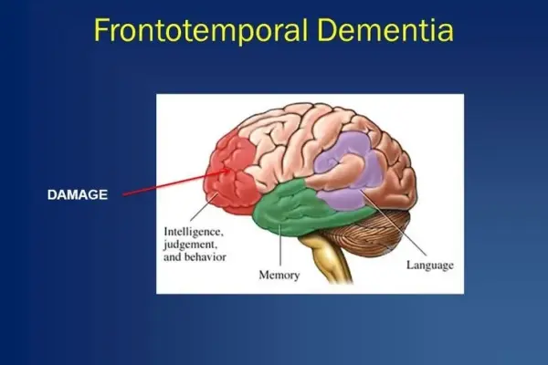 Frontotemporal dementia - A comprehensive guide