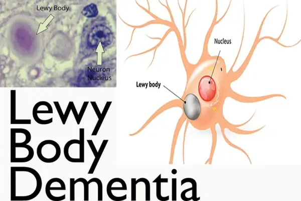 Understanding the unique symptoms of lewy body dementia