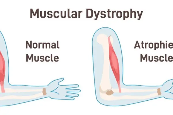 Muscular dystrophy- A guide to the different types and stages