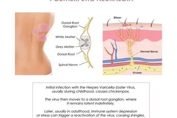 Post-herpetic neuralgia - Managing pain after a shingles rash