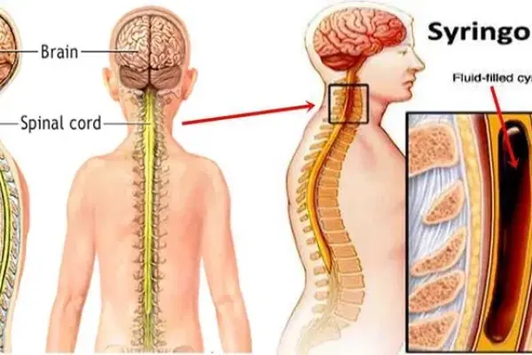 What causes syringomyelia and how is it diagnosed?